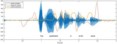 Voice Analysis to Differentiate the Dopaminergic Response in People With Parkinson's Disease